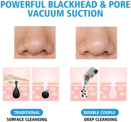 5 in 1 Multi-functional Black Head Removal